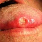 herpes sinh dục ở lưỡi